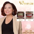 LÀM RĂNG Thay phong thủy, thay đổi vận mệnh tại Win Smile, tại sao không