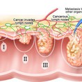 Phương pháp điều trị ung thư thực quản giai đoạn 3