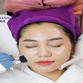 Phi kim trị sẹo rỗ có hiệu quả không Những điều cần biết