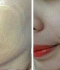 Hình ảnh: Hấp trăng phủ trăng da tái sinh và điều trị nám thâm sâu lâu năm Tại Thanhhang Beauty