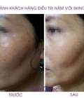 Hình ảnh: Điều Trị Nám Bằng Tia Laser cách trị nám hiệu quả nhất