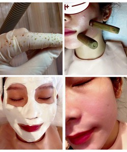 Spa trị mụn lăn ống tre, Địa chỉ trị mụn ống tre tại tphcm