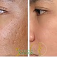 Điều trị sẹo với Fractional CO2 Laser