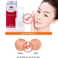 Tinh chất trị nám dưỡng trắng da A plus
