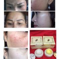Kem Tái Tạo Trị Thâm Nám, Mụn Ẩn LORBEAU hiệu quả sau 15 ngày