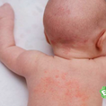 Cách trị rôm sảy cho trẻ em , mẹ nào cũng cần phải biết