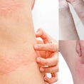 Những biểu hiện dị ứng thuốc sắt ở bà bầu