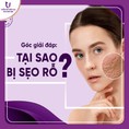 Trị sẹo rỗ Dứt điểm Da sáng mịn chỉ sau 1 liệu trình