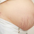 Cách để không bị rạn da khi mang thai