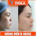 Nâng mũi B Nose là gì giá nâng mũi B Nose tại Đà Nẵng