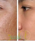 Hình ảnh: Điều trị sẹo với Fractional CO2 Laser