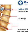 Hình ảnh: Nhận biết về Gai Cột Sống