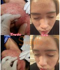 Hình ảnh: Spa trị mụn hiệu quả, spa trị mụn tận gốc, trị mụn giá rẻ