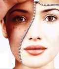 Hình ảnh: BioSurefaceTM Peel Phép nhiệm màu điều trị nám da hiệu quả
