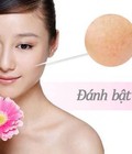 Hình ảnh: Trị sạch tàn nhang, Xua tan vết nám
