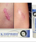 Hình ảnh: Kem trị sẹo, trị mụn Klirvin của Nga