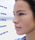 Hình ảnh: Tìm hiểu nguyên nhân gây tàn nhang và cách điều trị bằng tự nhiên
