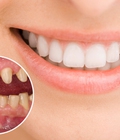 Hình ảnh: Bọc sứ cho răng có tốt không có ảnh hưởng gì không
