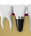 Hình ảnh: Thời gian cấy ghép implant bao lâu do yếu tố nào quyết định