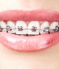 Hình ảnh: Thời gian niềng răng mất bao lâu phụ thuộc vào tiêu chí nào