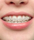 Hình ảnh: Quá trình niềng răng tại Nha khoa Bally