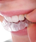 Hình ảnh: Các loại niềng răng tháo lắp hiệu quả nhất tháng 5