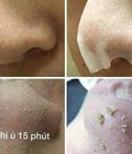 Hình ảnh: Doctor Li trị mụn số 1 sạch bay mụn cám, mụn đầu đen sau 15P ủ