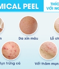 Hình ảnh: Sự thật về peel da trị mụn