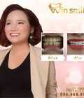 Hình ảnh: LÀM RĂNG Thay phong thủy, thay đổi vận mệnh tại Win Smile, tại sao không