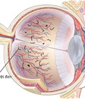 Hình ảnh: Dịch kính võng mạc nguyên nhân gây mù lòa