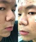 Hình ảnh: Dịch vụ trị mụn hiệu quả an toàn chi phí thấp