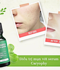 Hình ảnh: Serum trị mụn Caryophy