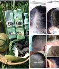 Hình ảnh: Điều trị nấm da đầu, trị gàu, giúp mọc tóc