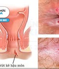 Hình ảnh: Địa chỉ chữa trị nứt kẽ hậu môn uy tín tại TP Thanh Hóa