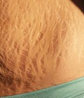 Hình ảnh: Hướng dẫn mẹ 3 cách trị rạn da sau sinh tại nhà hiệu quả, an toàn