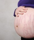 Hình ảnh: Cách chăm sóc da cho bà bầu trị rạn da siêu hiệu quả