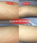 Hình ảnh: Cách chống rạn da bụng đùi hông tại Thẩm Mỹ Khánh Hương 27 Lê Văn Lương