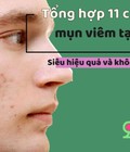 Hình ảnh: 11 cách trị mụn viêm tại nhà siêu hiệu quả và không tái phát