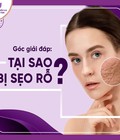 Hình ảnh: Trị sẹo rỗ Dứt điểm Da sáng mịn chỉ sau 1 liệu trình