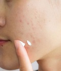Hình ảnh: Những cách điều trị sẹo rỗ tốt nhất cho làn da khỏe đẹp