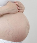 Hình ảnh: Muốn tránh rạn da ở bà bầu, mẹ cần làm gì