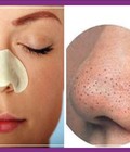 Hình ảnh: 5 Cách trị mụn ở mũi tại nhà hiệu quả