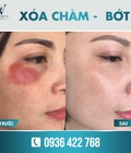 Hình ảnh: Bí quyết xóa vết bớt cực kỳ hiệu quả và an toàn