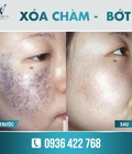 Hình ảnh: Bật mí giải pháp xóa chàm bẩm sinh cực kỳ hiệu quả