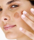 Hình ảnh: Phương pháp điều trị chàm bẩm sinh hiện đại nhất hiện nay