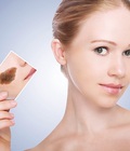 Hình ảnh: Chi phí xóa bớt bẩm sinh là bao nhiêu tiền hiện nay