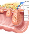 Hình ảnh: Một số nguyên nhân gây ung thư thực quản mà bạn cần biết