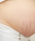 Hình ảnh: Mẹ bầu bị rạn da khi mang thai tháng thứ 8 có tự hết không