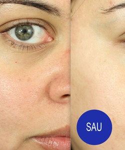 Trị mụn bằng phương pháp nào hiệu quả nhất hiện nay