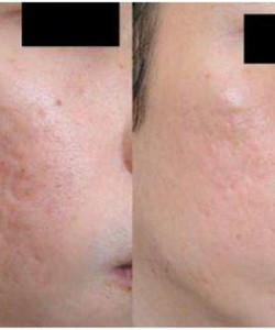 Trị Sẹo Rỗ Ở Đâu Hiệu Quả Với Tinh Chất Purifiant Complexe